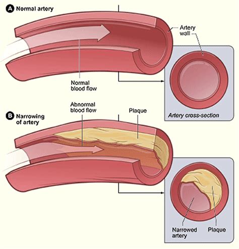 Atherosclerosis of Aorta: Causes and Symptoms .